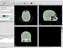 Invesalius generates 3d medical imaging reconstructions based on a sequence of 2d dicom files acquired with ct or mri equipments. Invesalius 3d Print Your Radiography