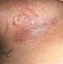 Image result for Candidiasis under breasts