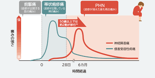 Definition of 帯状疱疹, meaning of 帯状疱疹 in japanese: å¸¯çŠ¶ç–±ç–¹ã®åˆä½µç—‡ã¨å¾Œéºç—‡ å¸¯çŠ¶ç–±ç–¹ Jp
