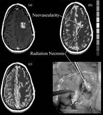 Moliterno gunel, jennifer, piepmeier, joseph m, baehring, joachim (eds.) free preview. Using Rcbv To Distinguish Radiation Necrosis From Tumor Recurrence In Malignant Gliomas International Journal Of Radiation Oncology Biology Physics