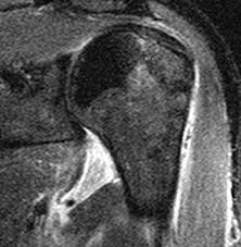 Mri is the modality of choice for assessment of hagl, especially as the finding may be difficult to diagnose on arthroscopy. Hagl Lesion Radsource