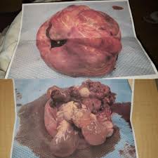 They are rare but can lead to symptoms such as excess hair growth if the cyst produces testosterone. A 13 Pound Cyst Teratoma Tumor That Took My Left Ovary With It This Had Hair Teeth And Brain Matter Enjoy Popping