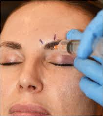 Image result for Forehead Regional Block