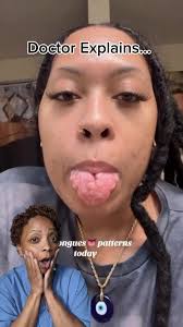 Image result for Fissured tongue