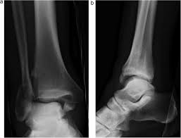 You can use pillows or a stool to this will ensure your ankle and foot do not become too stiff. Selective Fixation Of The Medial Malleolus In Unstable Ankle Fractures Injury