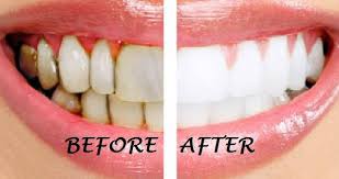 Oil pulling, which in ayurveda is called either 'gundusha' or 'kaval', is how to do oil pulling for teeth. Does Oil Pulling Work For Heart Dr Andrew Iverson Facebook