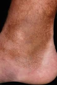 Image result for Pigment stains on the shin