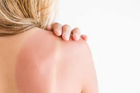 Sonnenbrand Behandeln Tipps Und Tricks Gala De