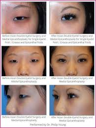 Plasticsurgery Beforeandafter Eyelidsurgery Surgery Before Double Eyelid Medial After Asian Eyes Eyelid Surgery Double Eyelid Asian Plastic Surgery