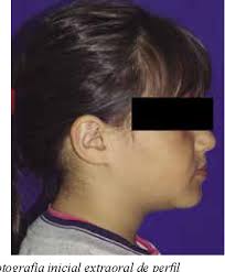 Tratamiento temprano de la maloclusión de clase III