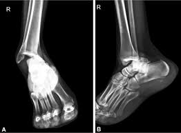 Image result for Ankle Dislocation