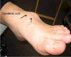 A cancer may also cause symptoms like fever, extreme tiredness (fatigue), or weight loss. Tumors Of The Foot Causes And Treatment Options Myfootshop Com