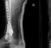 Medial versus lateral plating in distal tibial fractures: A ...