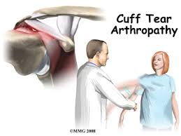 Image result for Rotator Cuff Injury