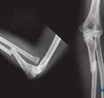 ORIF - Plating for Simple fracture of the ulna, with ...