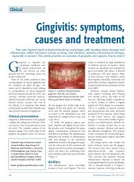 Most people get gingivitis at some point in their lives, and its mild symptoms. Pdf Gingivitis Symptoms Causes And Treatment