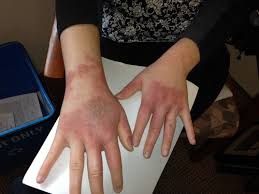 Image result for Photodermatitis