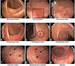 Image result for Proctitis