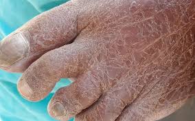 Image result for Ichthyosis