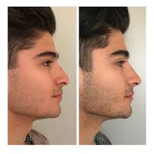 Natural And Subtle Non Surgical Nose Injections To Raise The Tip And Create A Straight Nose Nsnj Nonsurgicalnosej Nose Job Nose Fillers Nonsurgical Nose Job