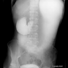 Sma Syndrome Radiology Case Radiopaedia Org