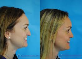 Rhinoplasty In 2020 Rhinoplasty Rhinoplasty Before And After Nose Surgery