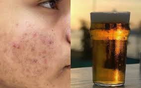 Properties of beer for the hair: Pimples Disappear With Beer 6 Ways In Which The Golden Liquid Is Good For Hair Skin Lifestyle News