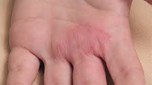 Top 5 Causes of Palm Rash