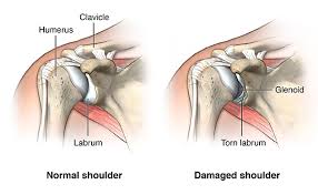 How to tell if your hip is dislocated. Shoulder Dislocation Cedars Sinai