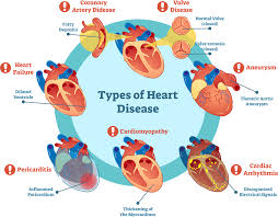 Chf is caused by either a the heart's function is measured based upon a percentage, also known as the ejection fraction (ef). Am I At Risk For Cardiovascular Disease University Diagnostic Medical Imaging