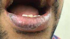 Image result for lichen planus on tongue)