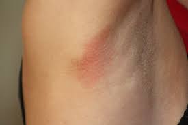 Rotung Mit Blasen Unter Den Armen Achseldermatitis