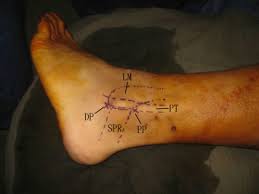 I really, really need help on this. Endoscopic Superior Peroneal Retinaculum Reconstruction Arthroscopy Techniques