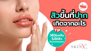 สิวขึ้นที่ปาก เกิดจากอะไร วิธีป้องกันไม่ให้สิวขึ้นปากด้วยตนเอง - SkinX