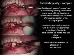 Image result for Sialoadenitis