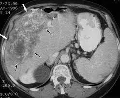 Colon cancer develops from growths within the wall of the intestine such as polyps or tumors. Spiral Ct Of Colon Cancer Imaging Features And Role In Management Radiographics