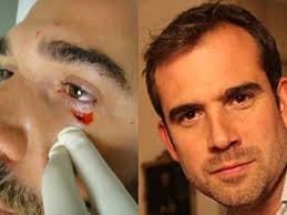 Or the doctor may need to remove the stitches in about 3 to 5 days. Do You Need Stitches For That Cut Lara Devgan Md Mph Facs