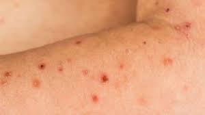 Latent autoimmune hepatitis triggered during interferon therapy in patients with chronic hepatitis c. Blickdiagnosen Wie Sterne Auf Der Haut Springermedizin De