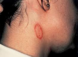 Maybe you would like to learn more about one of these? Cutaneous Subcutaneous Mycoses Basicmedical Key