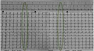 Outline of ecg interpretation 2018 update (pdf). Permanent His Bundle Pacing A Programming And Troubleshooting Guide Sciencedirect