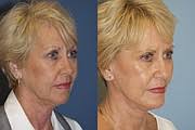 Cosmetic procedures are becoming more popular in Chattanooga, a result of  the 'Zoom Boom'