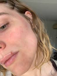 What causes itchy dry face bumps?