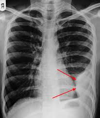 We did not find results for: Pleural Effusion Causes Types Symptoms Diagnosis And Treatment
