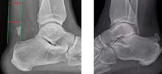 Calcific Achilles Tendonitis In Athletes Podiatry Today Hmp Global