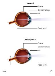 Image result for Presbyopia