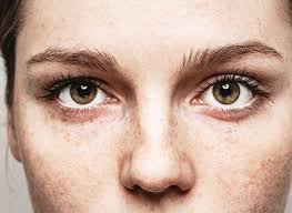 Black And Blue Eyes After Head Injury 23 Questions To Ask Yourself When You Re Stressed Out Dry Eyes Freckles Beautiful Freckles