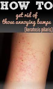 Bumps On The Back Of Arms Health And Beauty Tips Skin Bumps Beauty Treatments