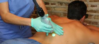 Laser hair removal is appealing for men who are uncomfortable with excess hair on their back, chest, stomach, or all over. Laser Hair Removal For Men Chicago Il Lapiel Laser Center
