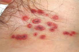 Image result for sore skin in the groin area