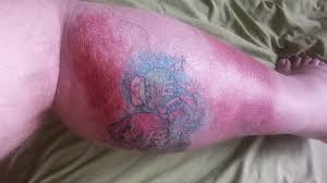 Tattoo Redness Why Is My New Tattoo Red Inflamed Authoritytattoo